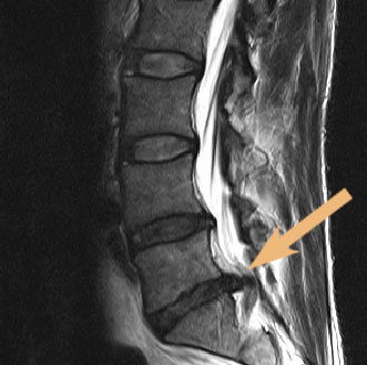 herniated disc x ray