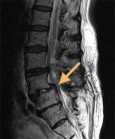 Gleitwirbel Symptome Diagnostik Behandlung Beta Klinik