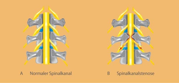 Neurochirurgie-Schaubild-Spinalkanalstenose