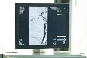 Beta-Angiologie-Bildschirm-Angiographie-Untersuchung