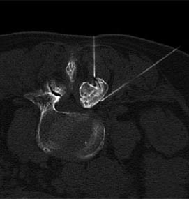 Neurochierurgie-CT-Bildgebung-von-mikrotherapeutischer-Facetteninfiltration