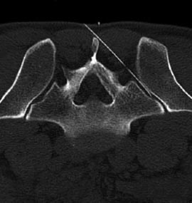 Neurochirurgie-CT-Bildgebung-von-mikrotherapeutischer-ISG-Infiltration