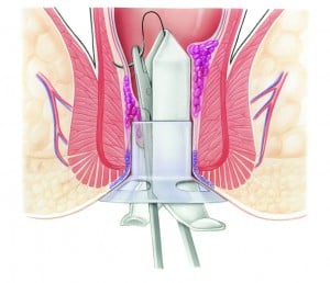 Schritt 2 der Stapler-Haemorrhoidpexie nach Longo