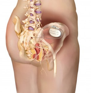 Prinzip der sakralen Neuromodulation (© Medtronic)