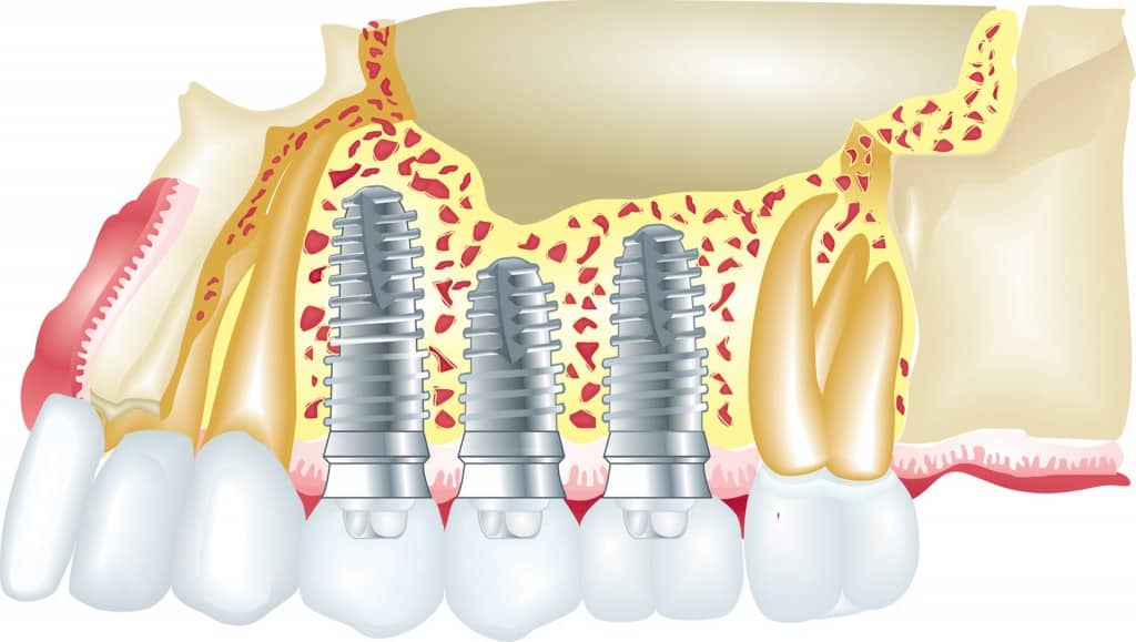 Bonn Implant - Oralchirurgie & Implantologie www.betaklinik.de