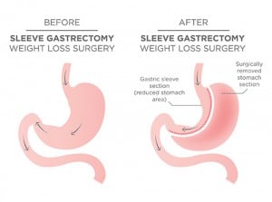 Behandlung-Adipositas-Gastric-Sleeve-Verfahren