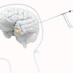 New-correct-Visualase-brain-illustration-teaser