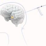 Visualase-Brain-Illustration