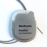 Schmerzschrittmacher-der-Firma-Medtronic-Beta-Klinik