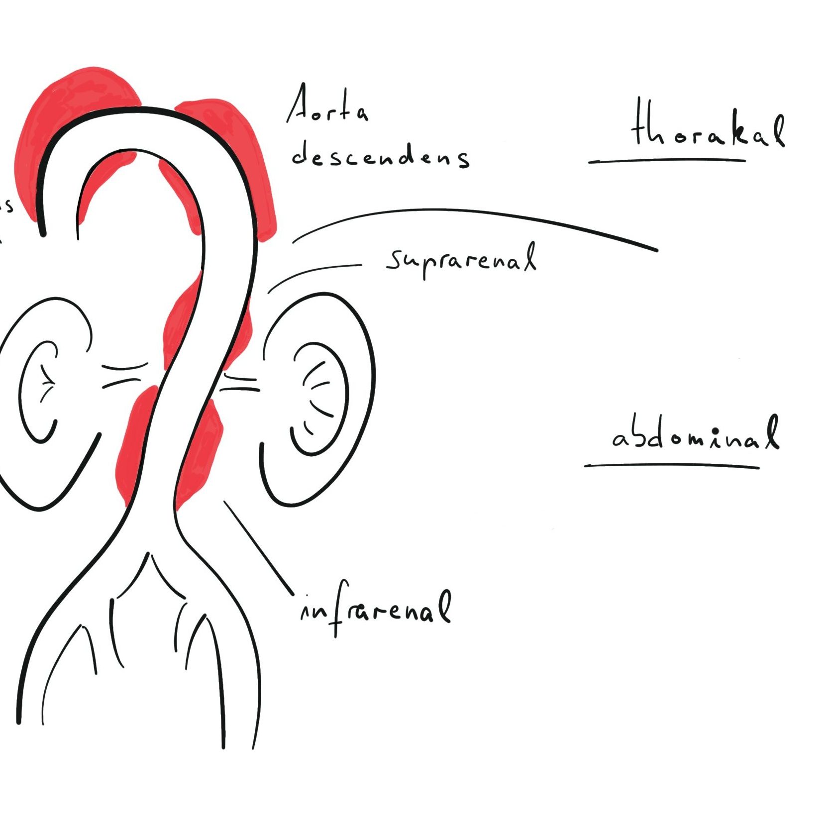 SKizze aortenaneurysma