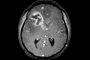 MRT Aufnahme eines Glioblastom