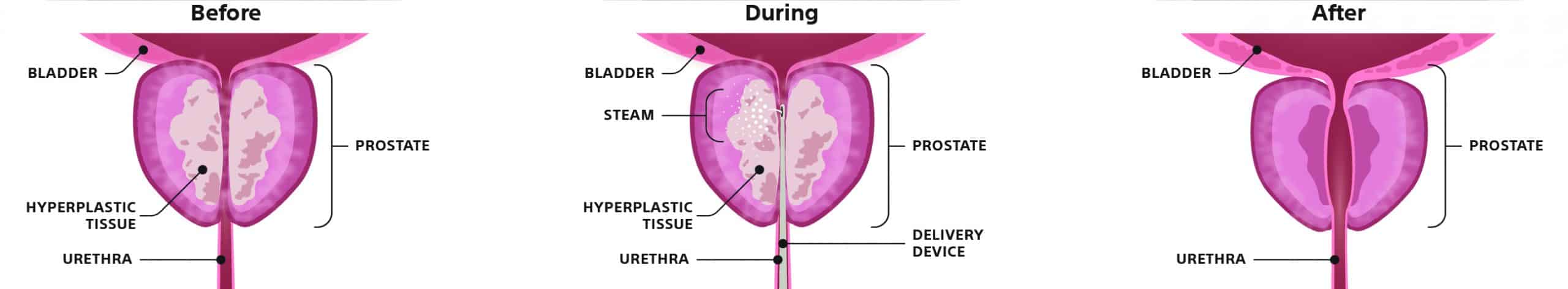 Rezum Therapie bei Prostatavergrößerung