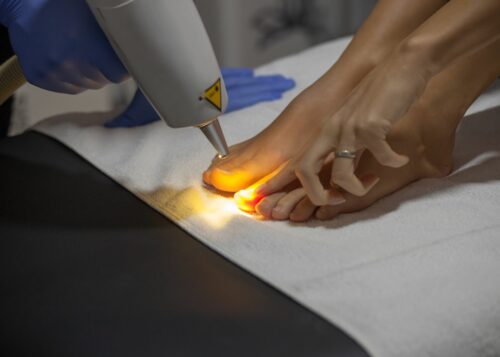 Ein Nagelpilz kann dank modernster Lasertechnologie schnell behandelt werden.