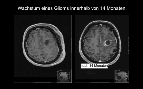 Wachstum eines Glioms innerhalb von 14 Monaten
