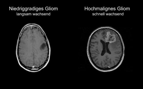 Gliome werden in verschiedene Grade aufgeteilt.