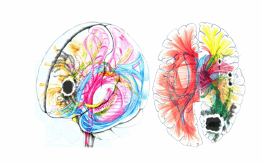 Bunte 3D-Darstellung von Nervenbahnen im menschlichen Gehirn mit markierten Tumorarealen, seitlich und frontal geschnitten – visualisiert für die präzise Hirntumor-Diagnostik.