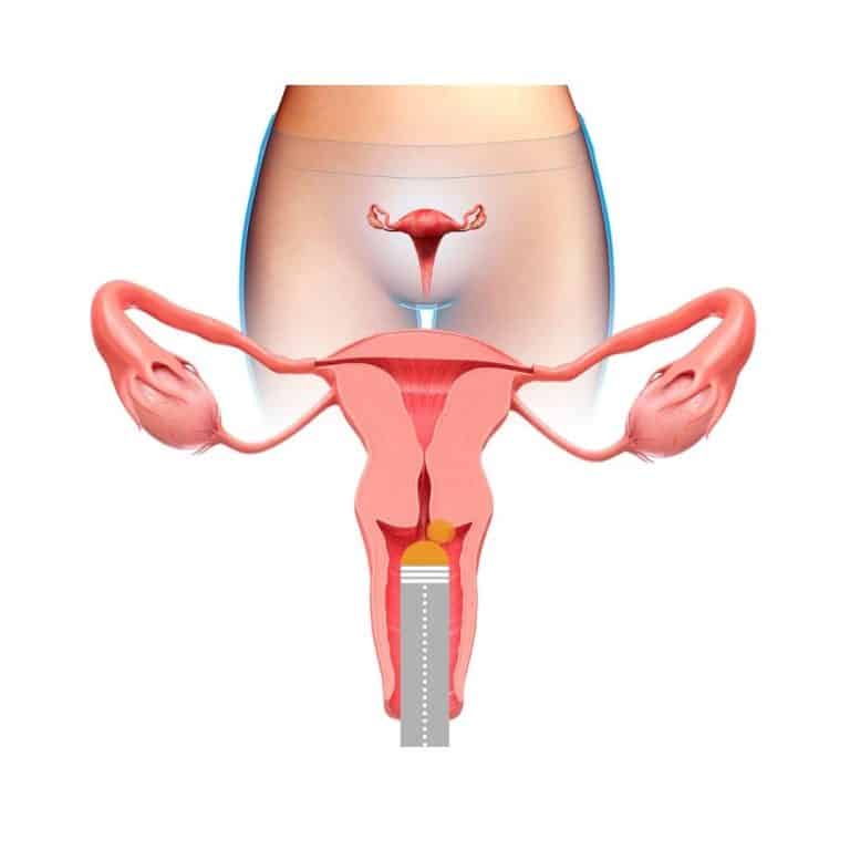 Illustration Intravaginale Lasertherapie