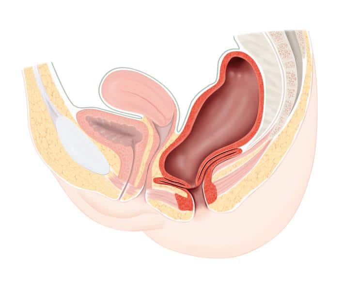 Illustration Rectum mit einer Stuhlentleerungsstörung