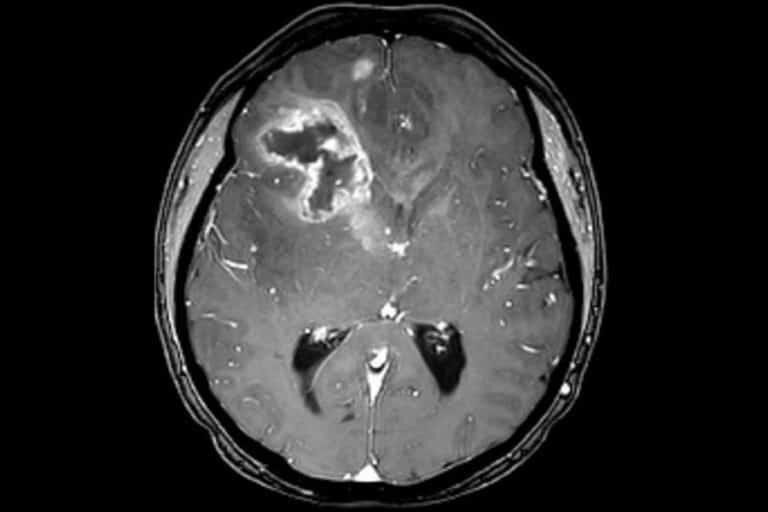 CT Aufnahme eines Gehirns