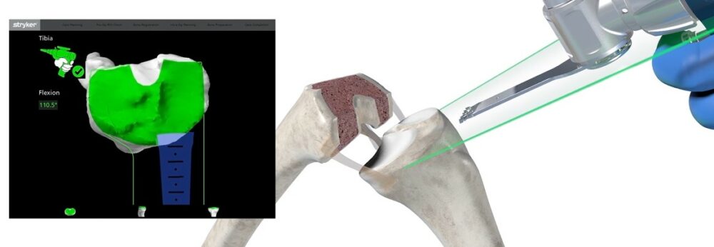 Ein chirurgisches Werkzeug bearbeitet ein künstliches Kniegelenk, daneben ein Bildschirm mit grüner 3D-Darstellung des Gelenks.