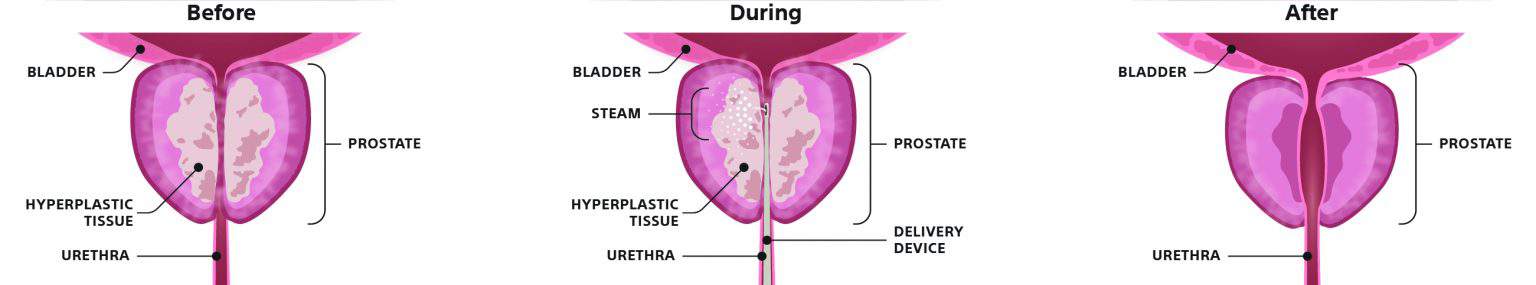 Drei Diagramme der Prostata vor, während und nach einer Behandlung mit Dampf.