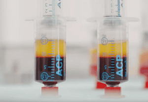 Entnommene Mesenchymale Stammezellen aus dem Fettgewebe in Spritzen