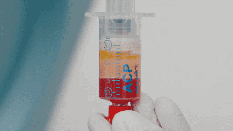 Eine Spritze mit roter und gelber Flüssigkeit wird von einer behandschuhten Hand gehalten.