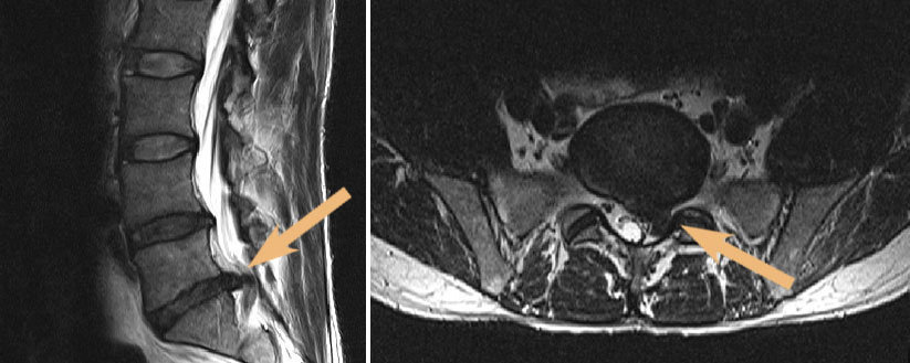 MRT-Bild eines großen Bandscheibenvorfalls im untersten Bandscheibenfach der Lendenwirbelsäule (links). Querschnittdarstellung des Bandscheibenvorfalls (rechts).