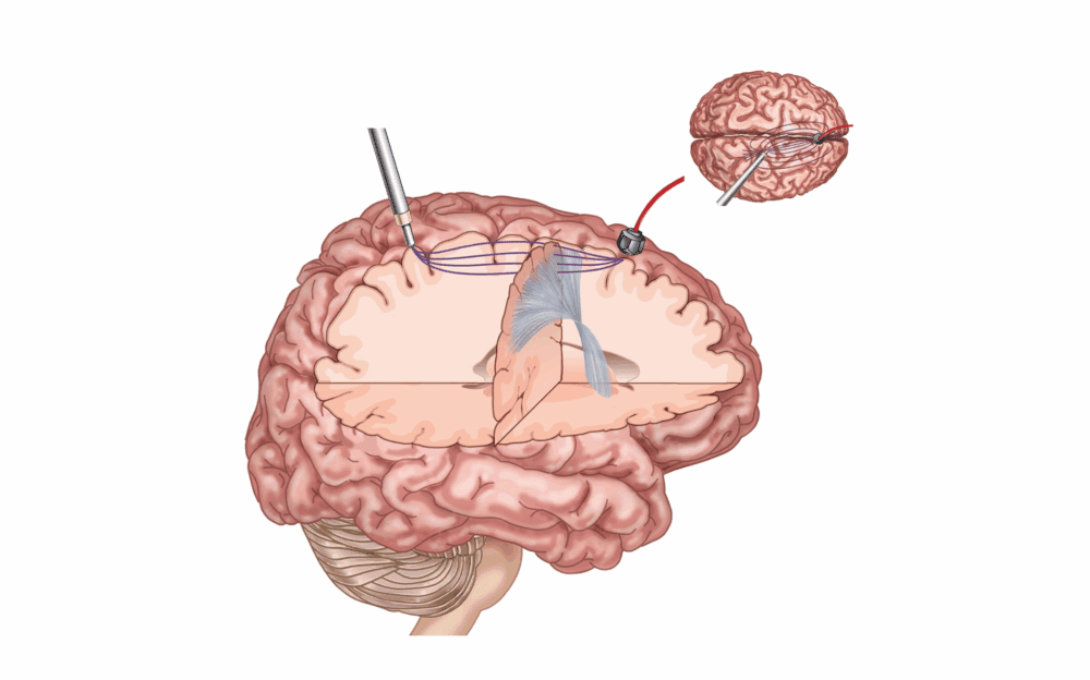 Medizinische Illustration eines neurochirurgischen Eingriffs am Gehirn mit Darstellung von Elektrodenplatzierung und Zugangspfad.