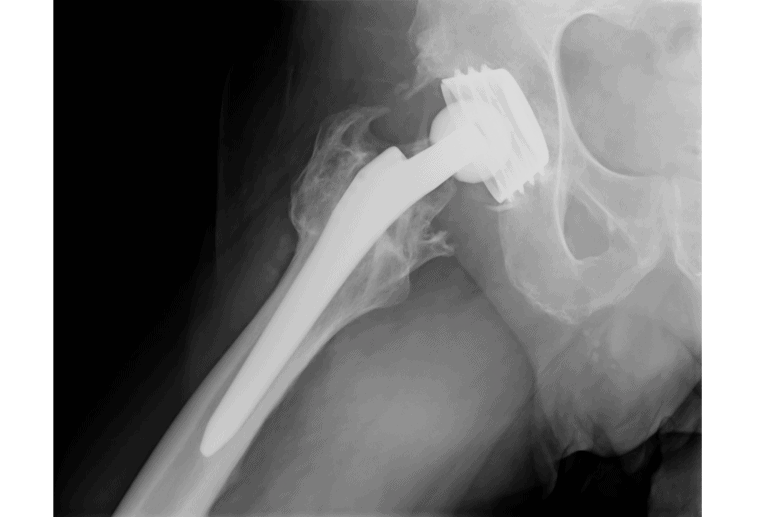 Röntgenbild einer Hüftprothese im Beckenbereich, Metallimplantat sichtbar.