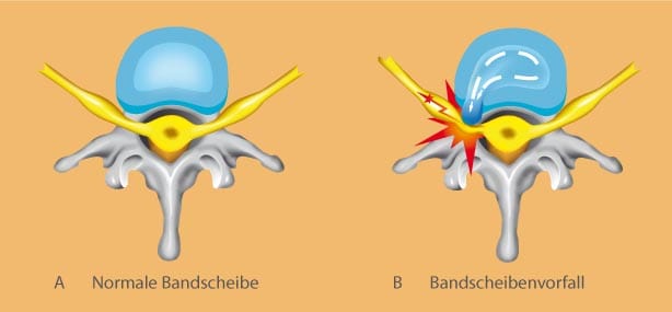 Abbildungen einer normalen Bandscheibe und eines Bandscheibenvorfalls.