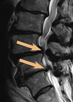 Die Abbildung zeigt eine hochgradige Spinalstenose, die in zwei Höhen auf die Nervenwurzeln drückt (Nervenwurzelkompression).