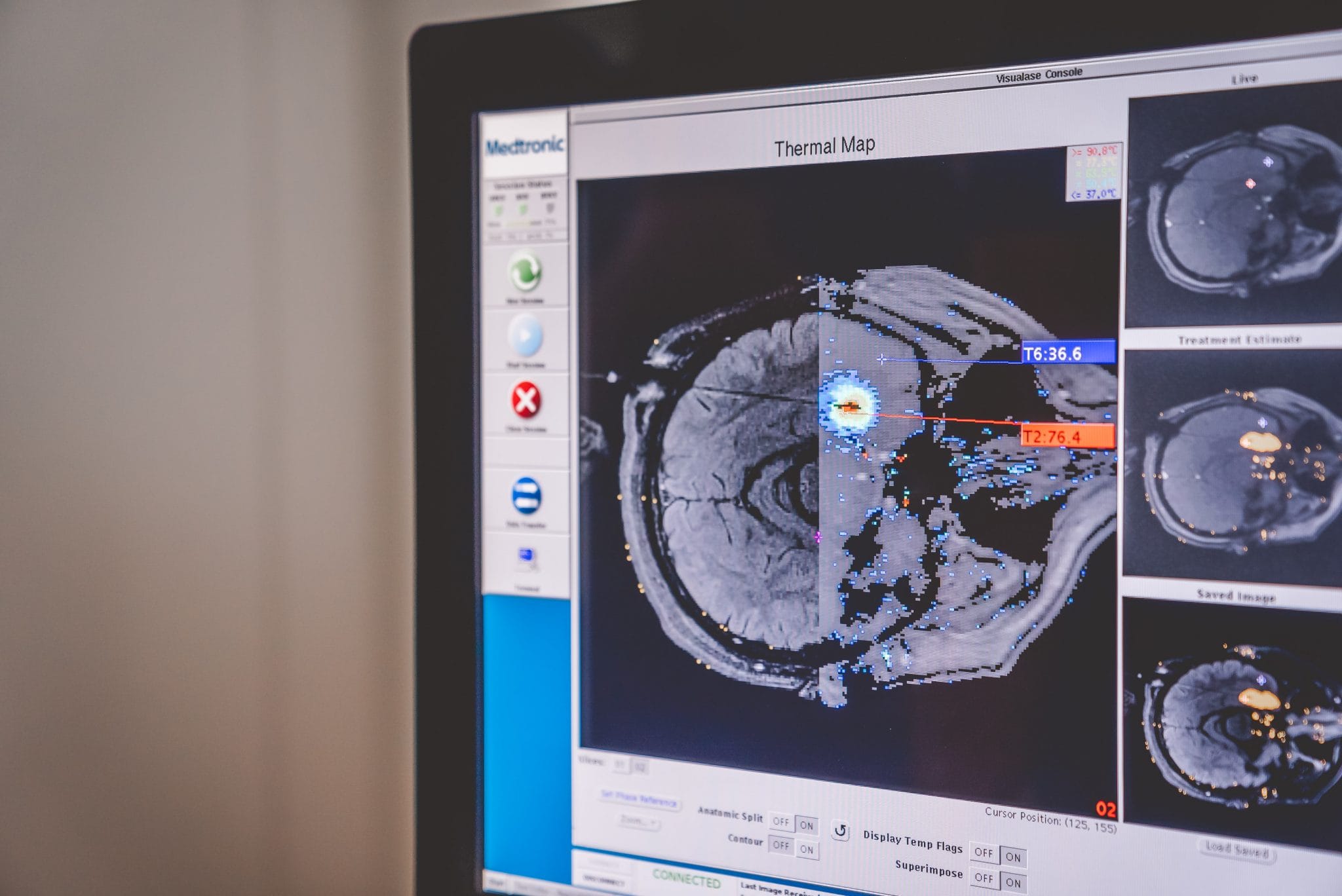 Visualase - Aufnahme des Gehirns