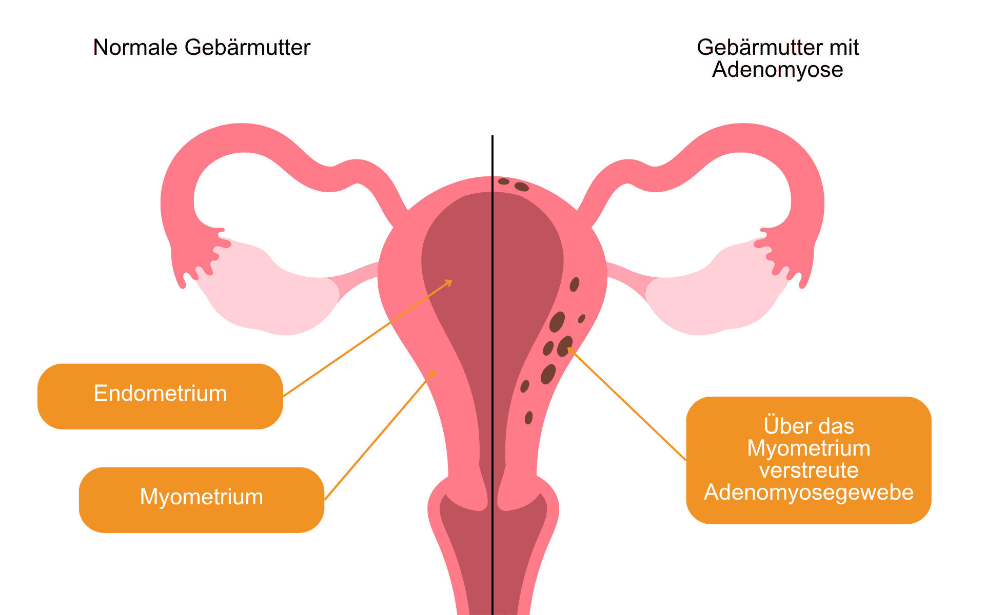 Gegenüberstellung Uterus mit und ohne Adenomyose