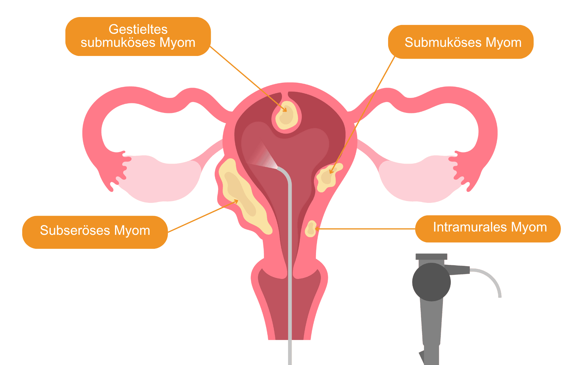 Ein Myom der Gebärmutter (Uterusmyom) ist ein gutartiger Knoten, der aus Muskel- und Bindegewebe der Gebärmutterwand entsteht.
