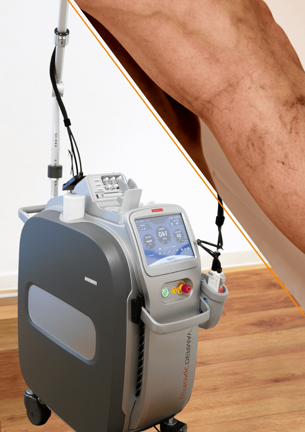 DermaV Laser 2