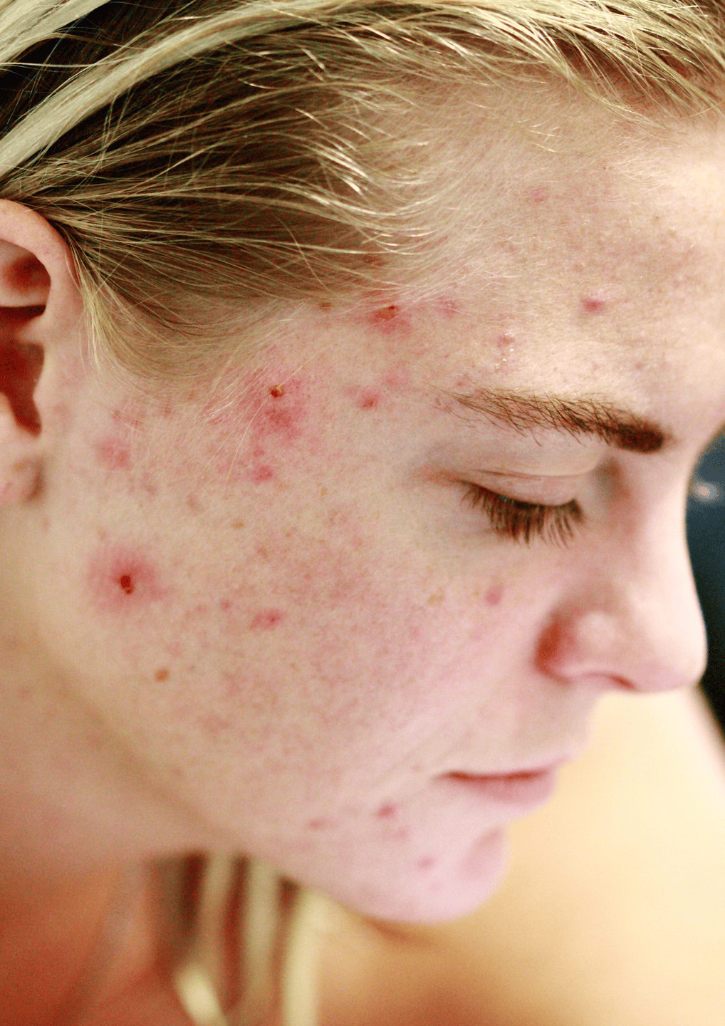 Akne im Gesicht
