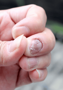 Nagelpilz an der Hand