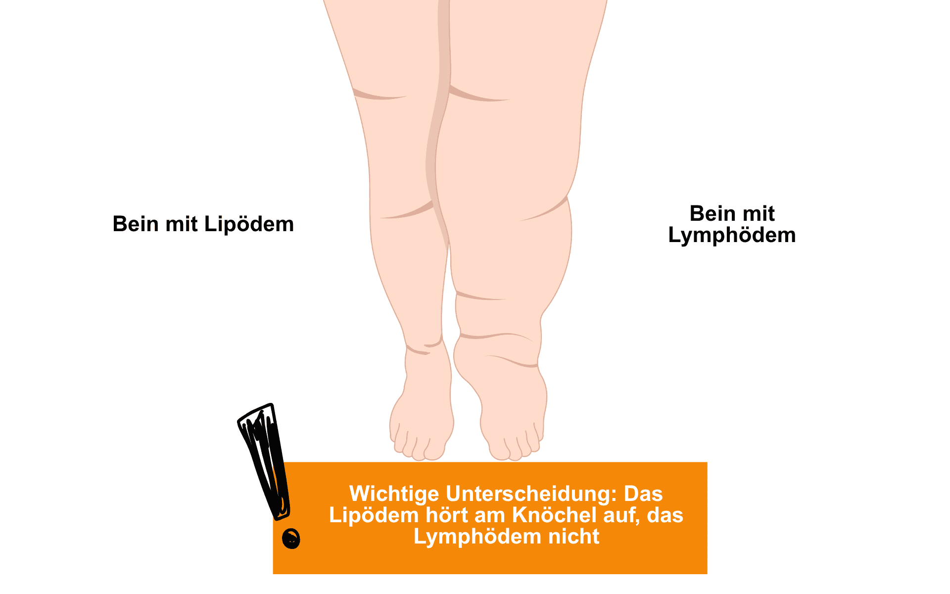 Ein Bein mit Lymphödem unterscheidet sich visuell von einem Bein mit Lipödem.