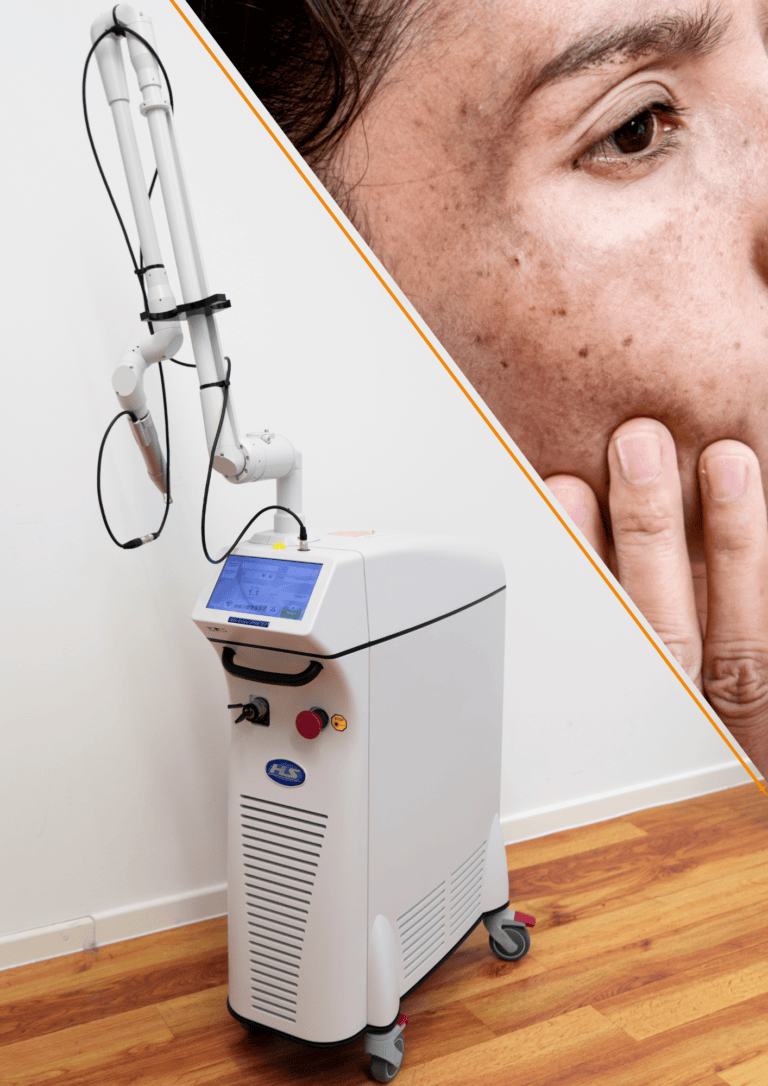 Abbildung von einem Laser gegen Pigmente