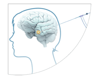 Grafische Darstellung LITT