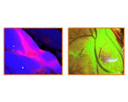 Beispiele für Fluoreszenz intraoperativ: 5-ALA für Gliome und Fluoreszin für Gehirnmetastasen