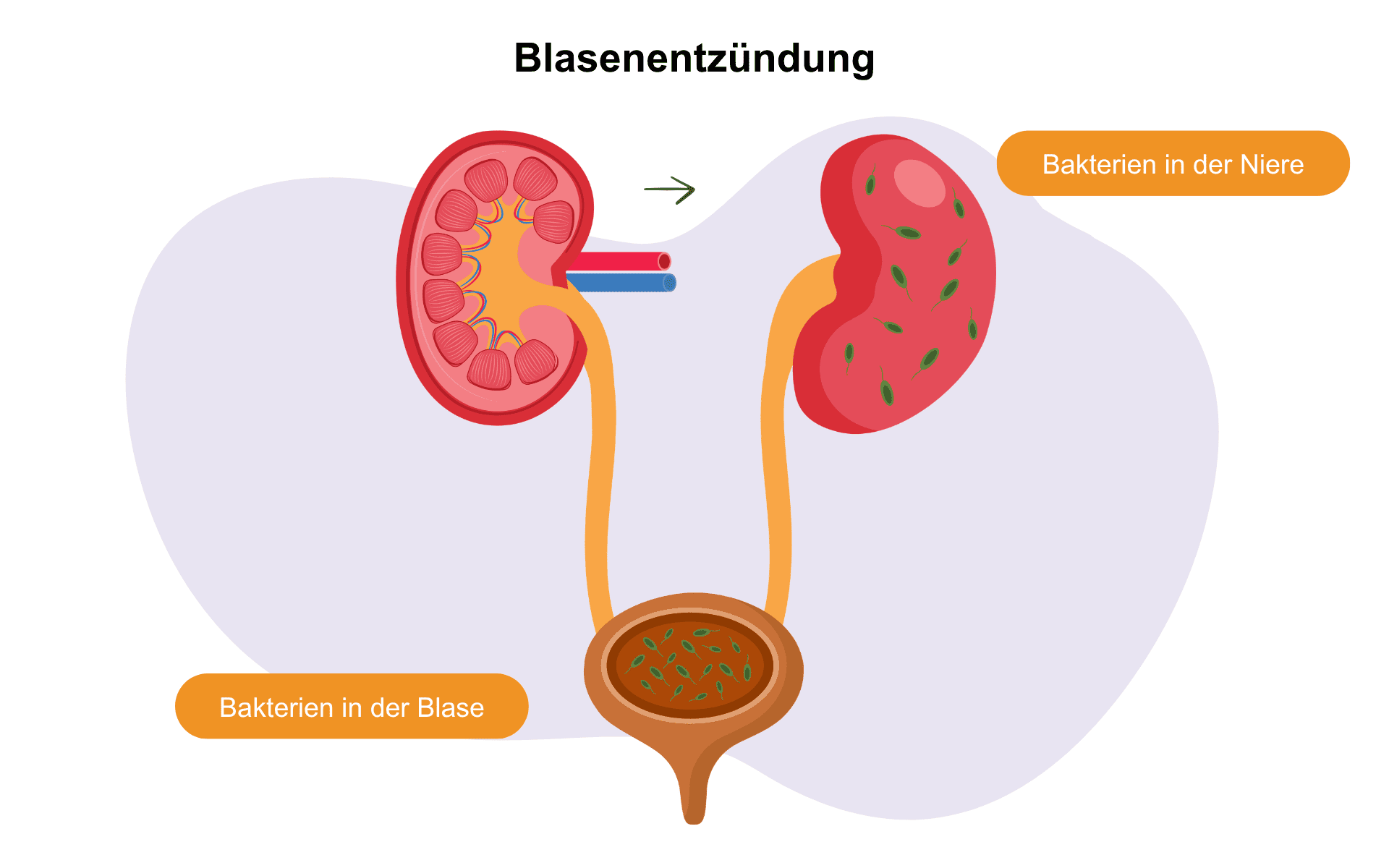 Das Bild zeigt eine Blase mit Bakterien drin.