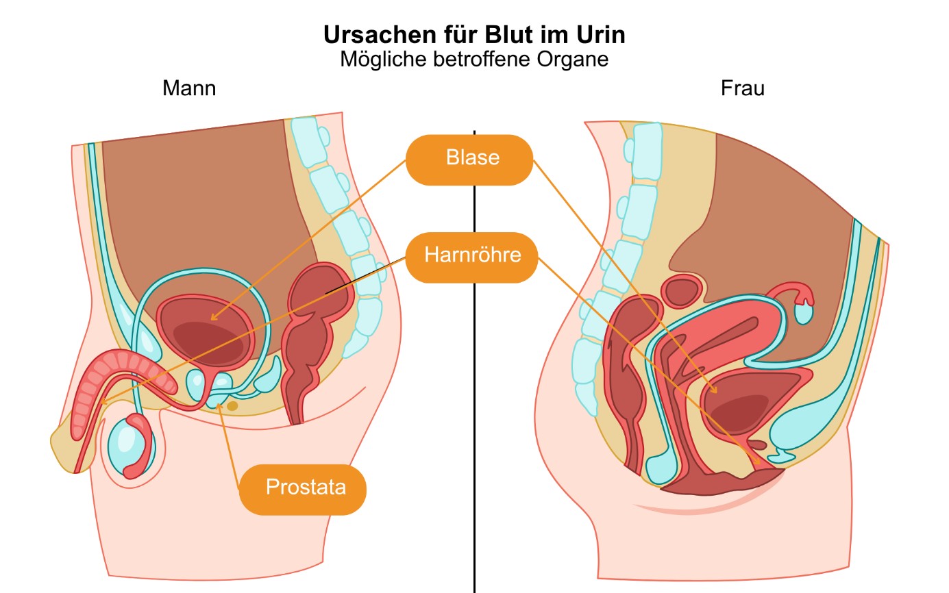 prostata_grafik