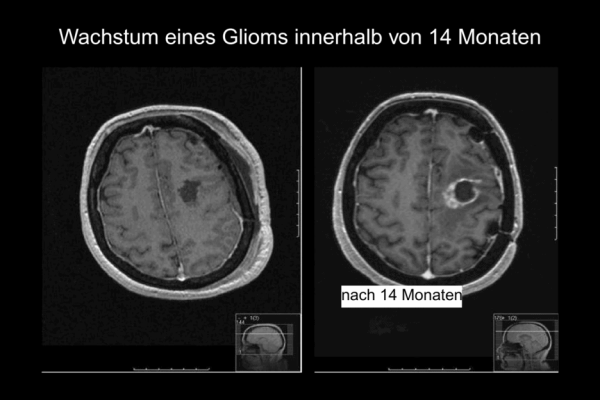 Grafik Wachstum eines Glioms innerhalb von 14 Monaten - zwei CTs gegenübergestellt