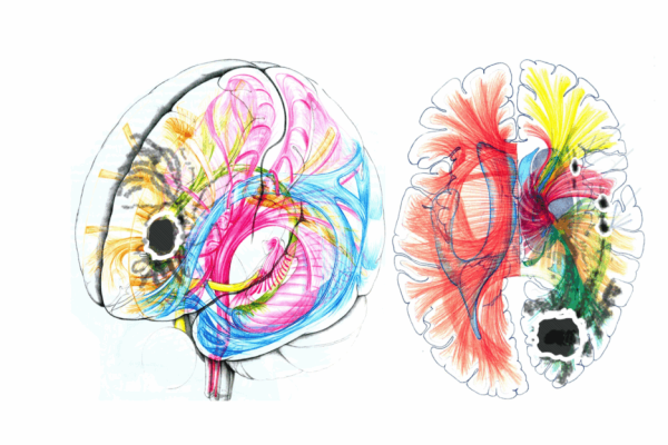 Hirntumor Diagnostik: Farbige medizinische Illustration neuraler Faserbahnen im menschlichen Gehirn mit sichtbarer Läsion.